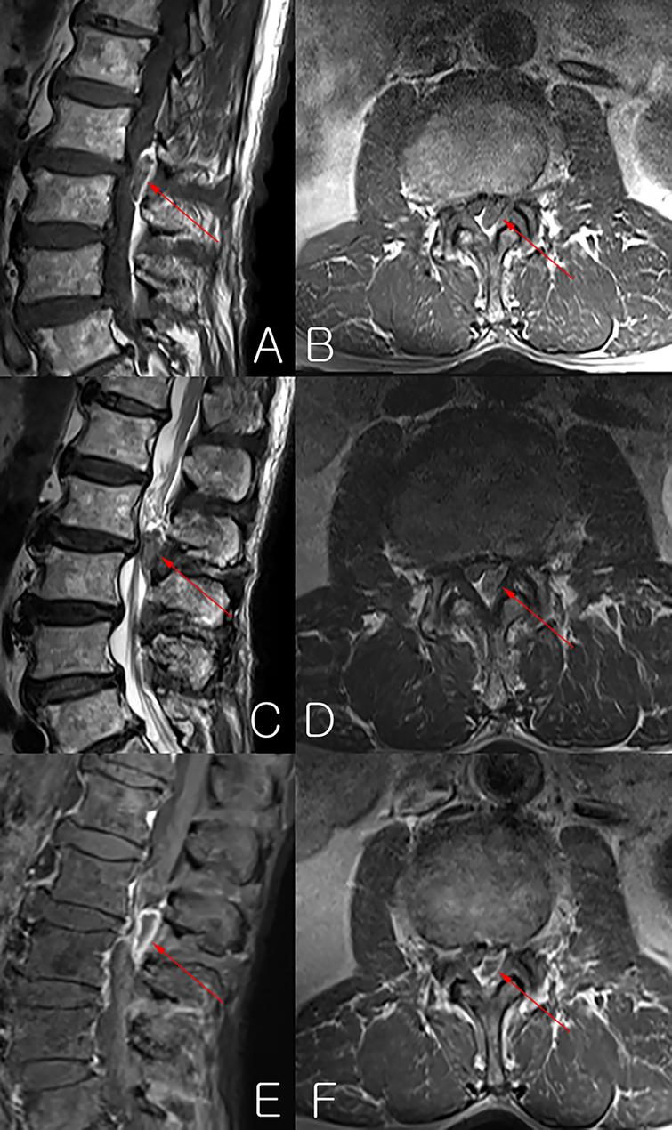 Posterior epidural disc fragment masquerading as spinal tumor: Review ...