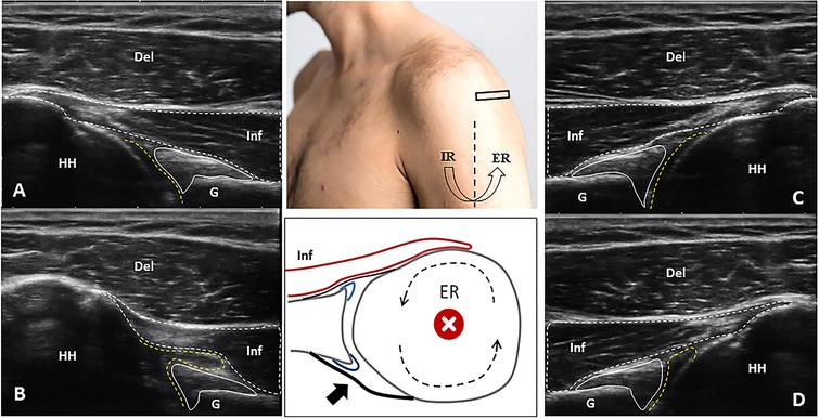 Looking into the joint when it is frozen: A report on dynamic shoulder ...