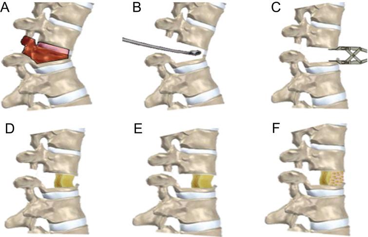 Anterior column opening structural bone grafting with posterior column ...