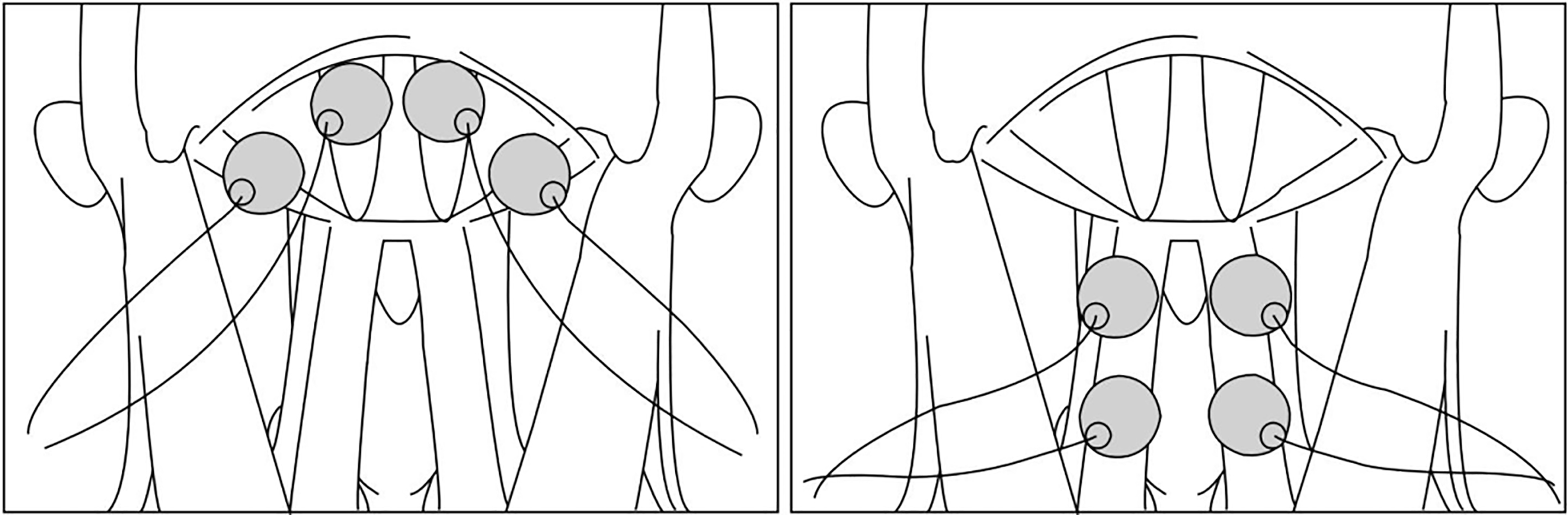 A Clinical Approach to Neuromuscular Electrical Stimulation for Speech and  Swallow in an Acute Rehabilitation Facility