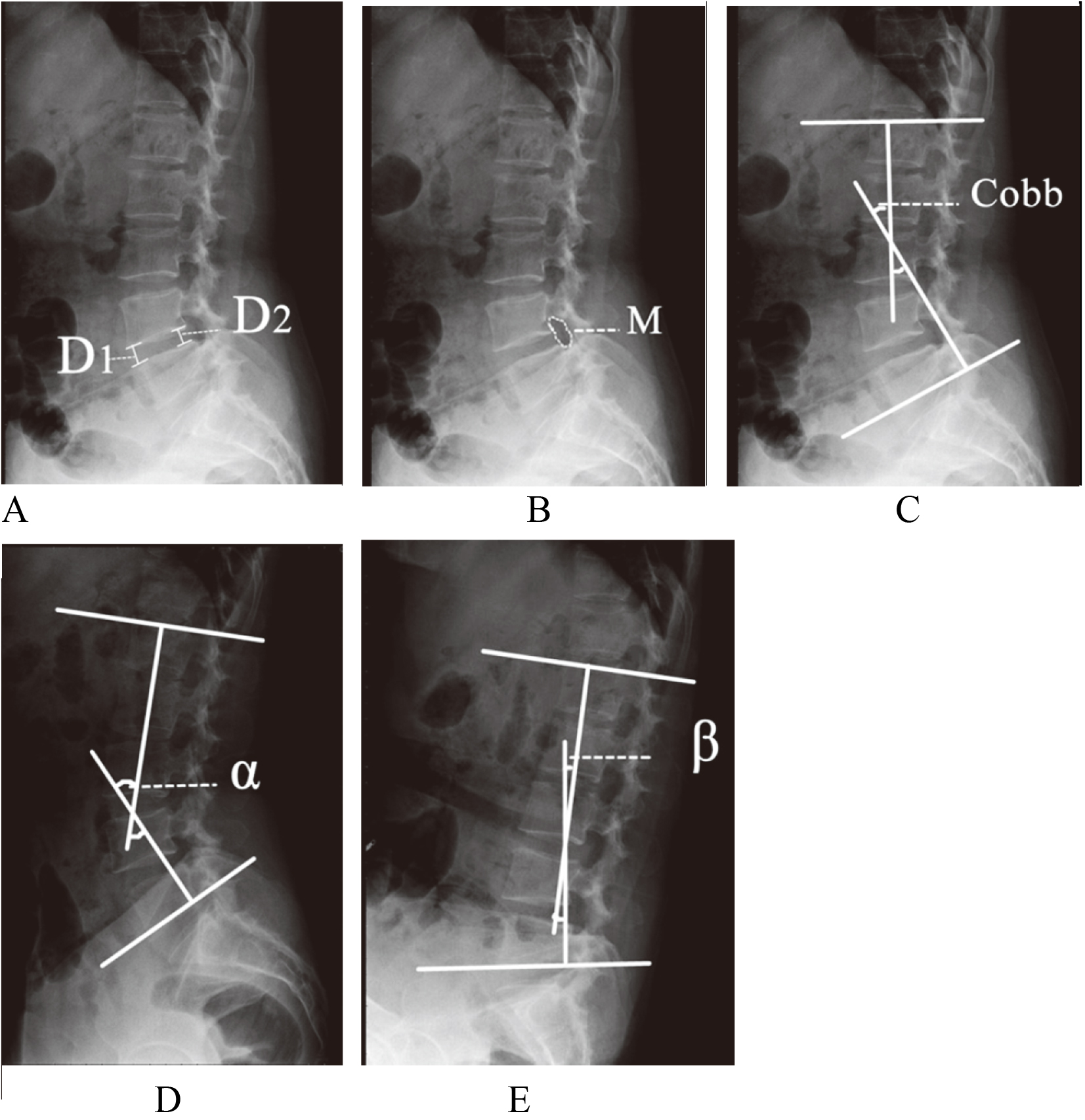 Single-segment central lumbar spinal stenosis: Correlation with lumbar ...