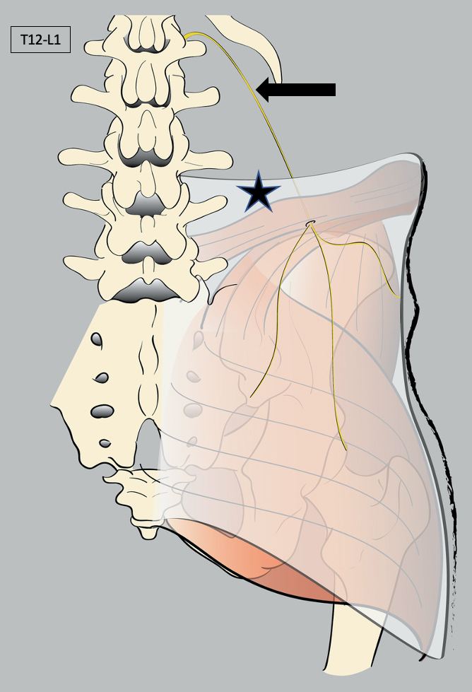 Pattern of left flank pain from the thoracolumbar junction syndrome.