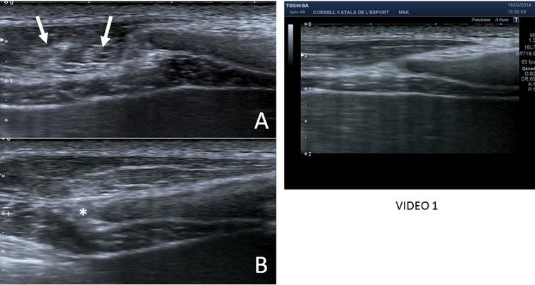 Slipping rib syndrome: A clinical and dynamic-sonographic entity. A ...