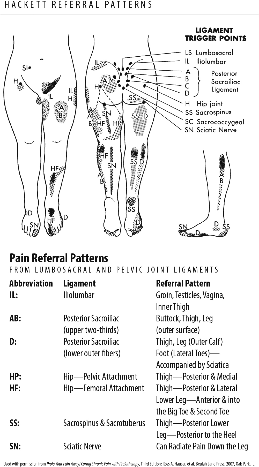 iliolumbar ligament pain pattern