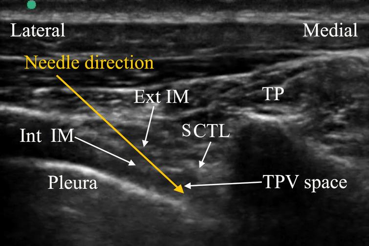 Effectiveness and safety of ultrasound-guided thoracic paravertebral ...