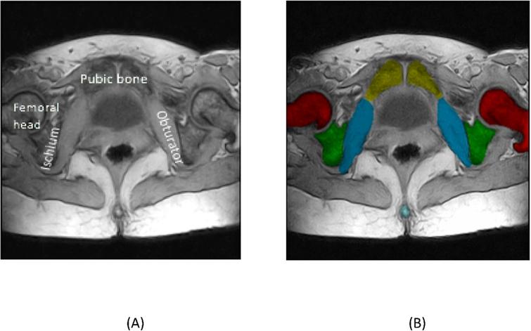 Methodology for 3D image reconstruction of the female pelvis from