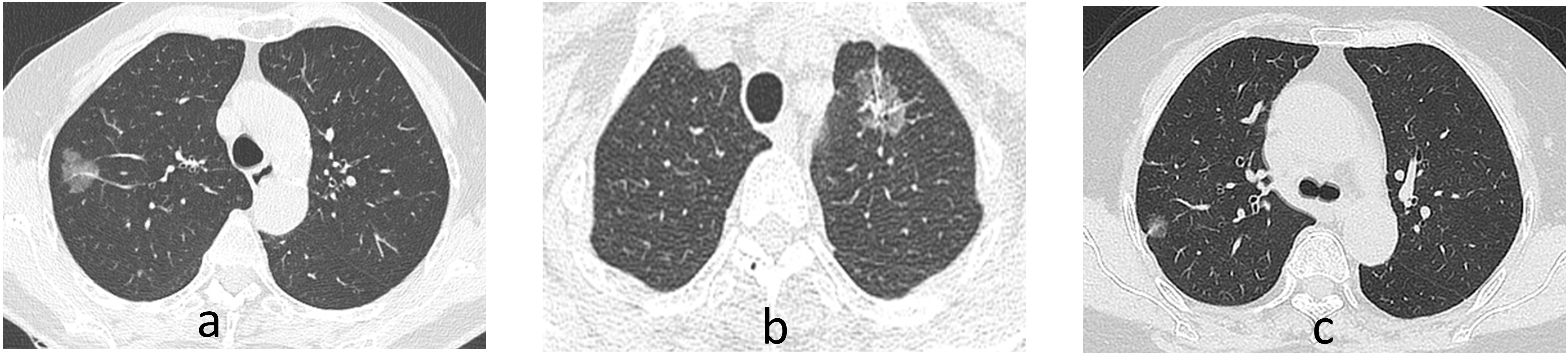 A Clinical Spectrum Of Resectable Lung Adenocarcinoma With ...