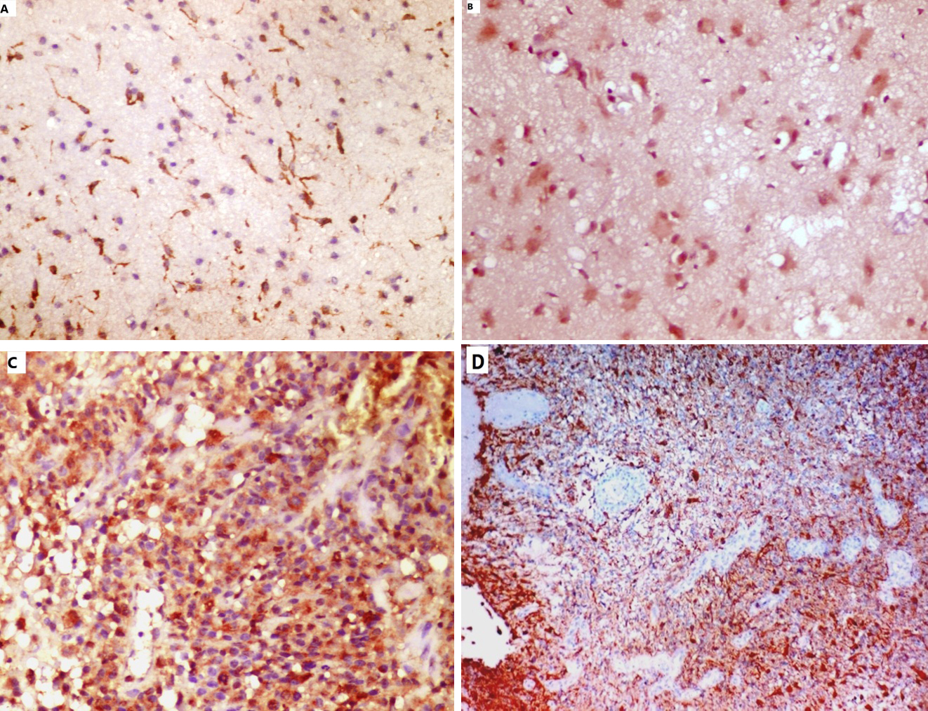 The clinicopathological significance of CD133 and Sox2 in astrocytic ...