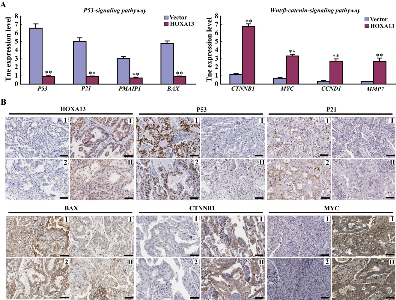 Homeobox-A13 acts as a functional prognostic and diagnostic biomarker ...