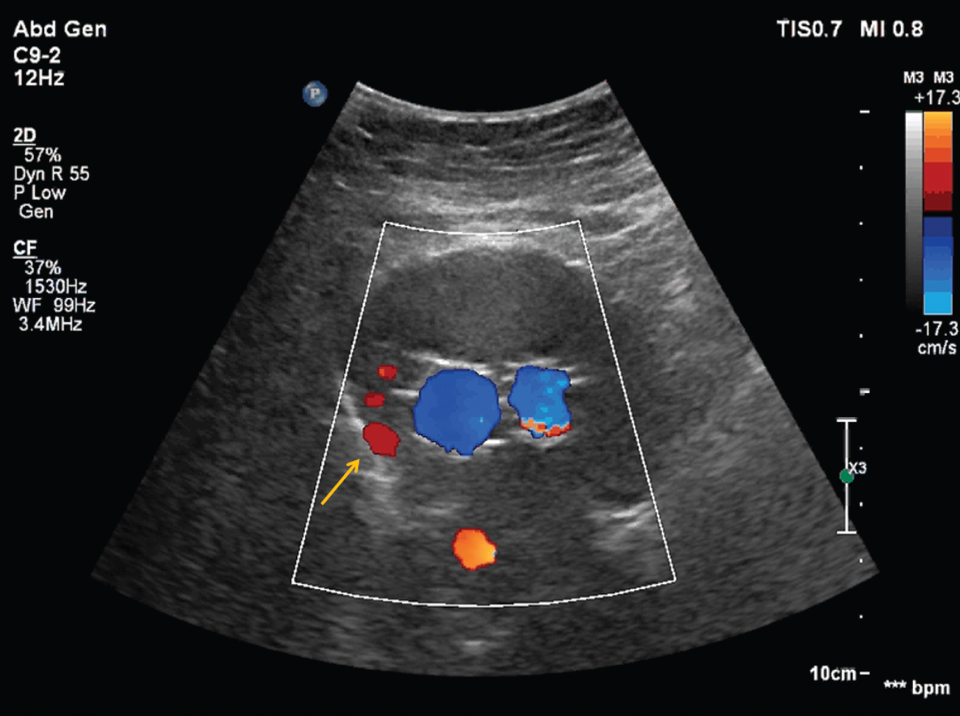 type 3 endoleak