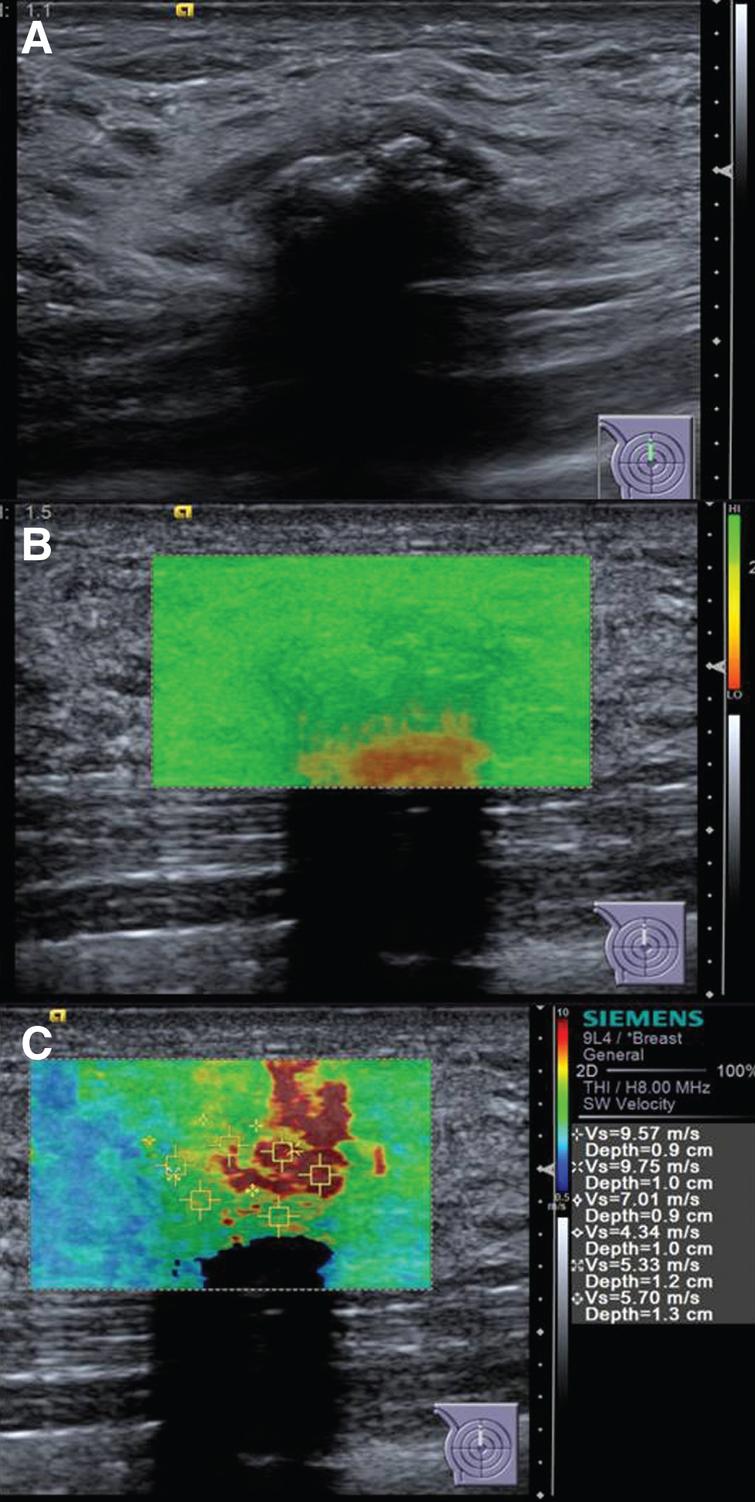 A novel two-dimensional quantitative shear wave elastography to make ...