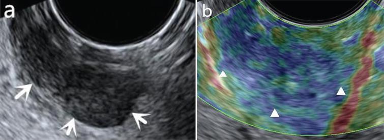 Comparison Of Elastography Based On Transvaginal Ultrasound And Mri In