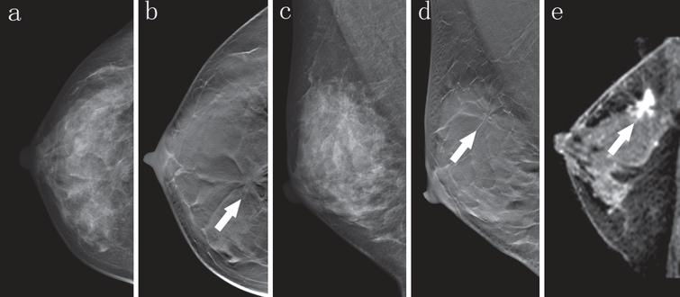 Digital breast tomosynthesis plus mammography, magnetic resonance ...