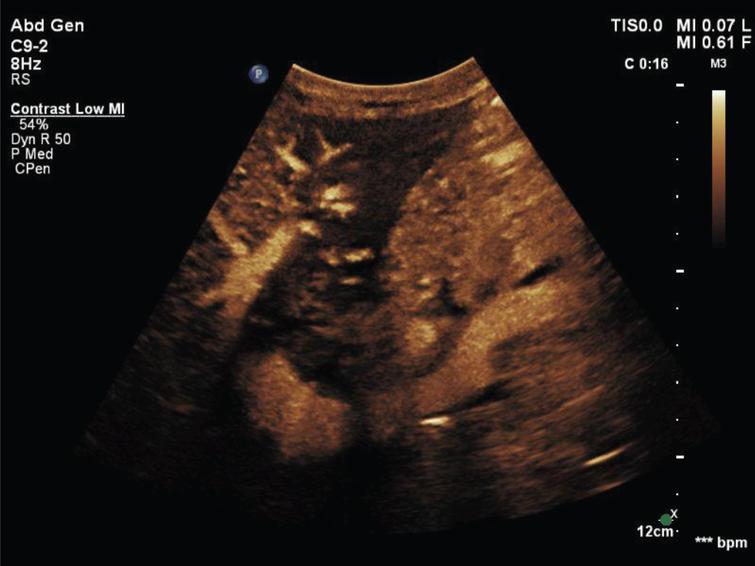 Diagnostic Accuracy Of Contrast Enhanced Ultrasound Ceus In Monitoring Vascular Complications In Patients After Liver Transplantation Diagnostic Performance Compared With Histopathological Results Ios Press