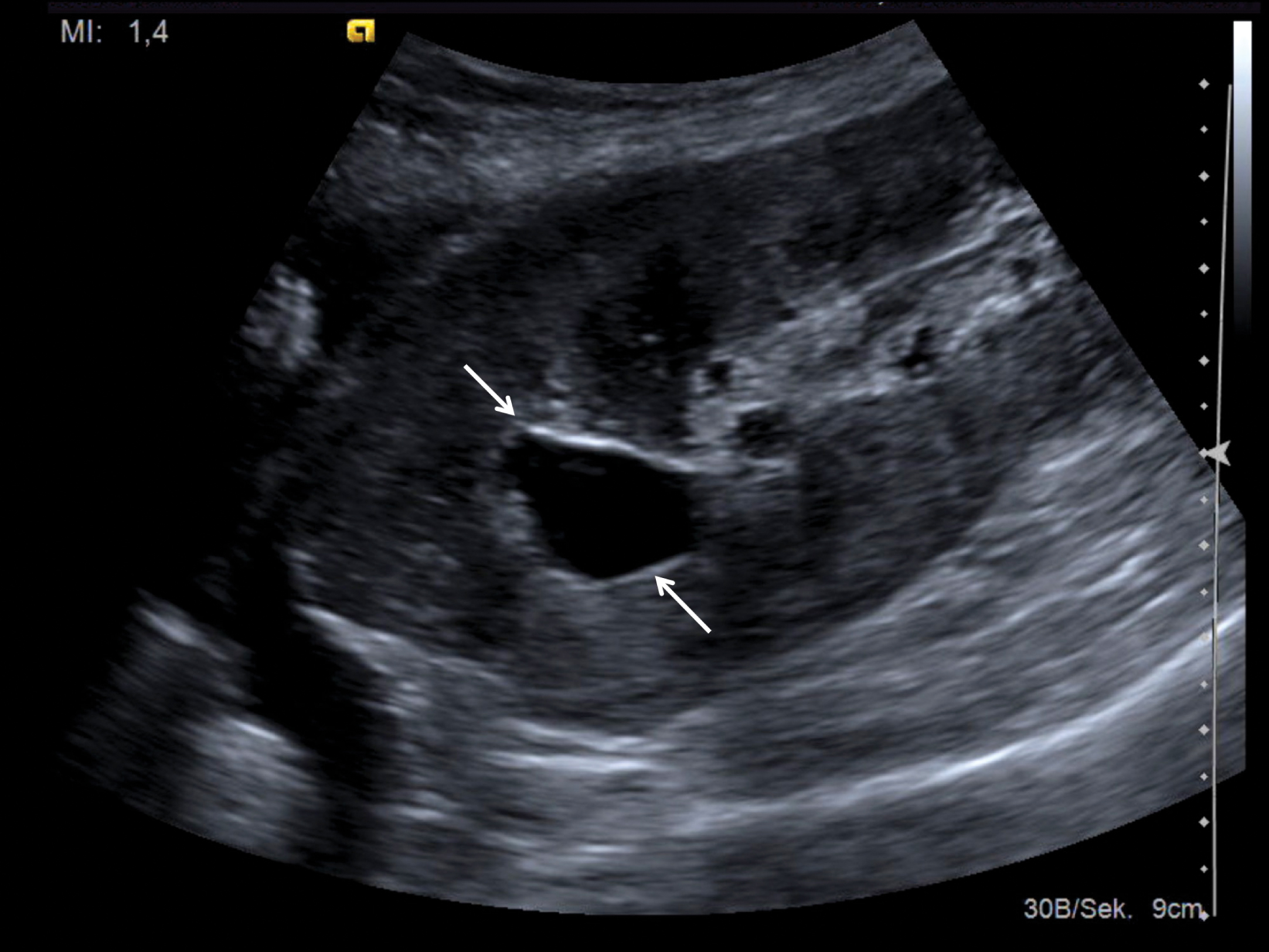 The diagnostic value of contrast-enhanced ultrasound (CEUS) as a new ...