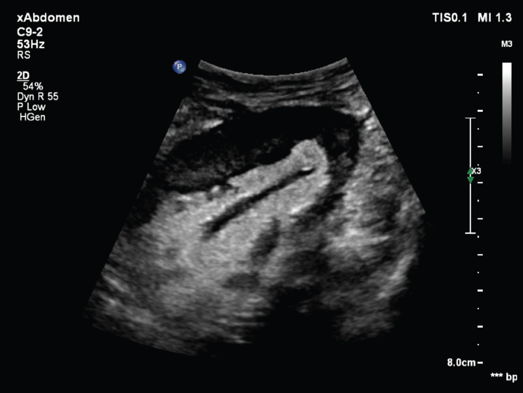 Vascular Rejection In Renal Transplant: Diagnostic Value Of Contrast ...