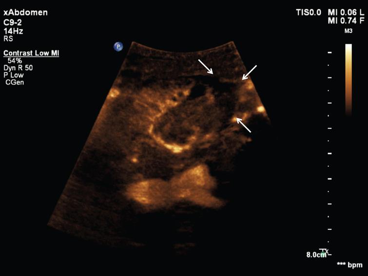 Vascular rejection in renal transplant: Diagnostic value of contrast ...