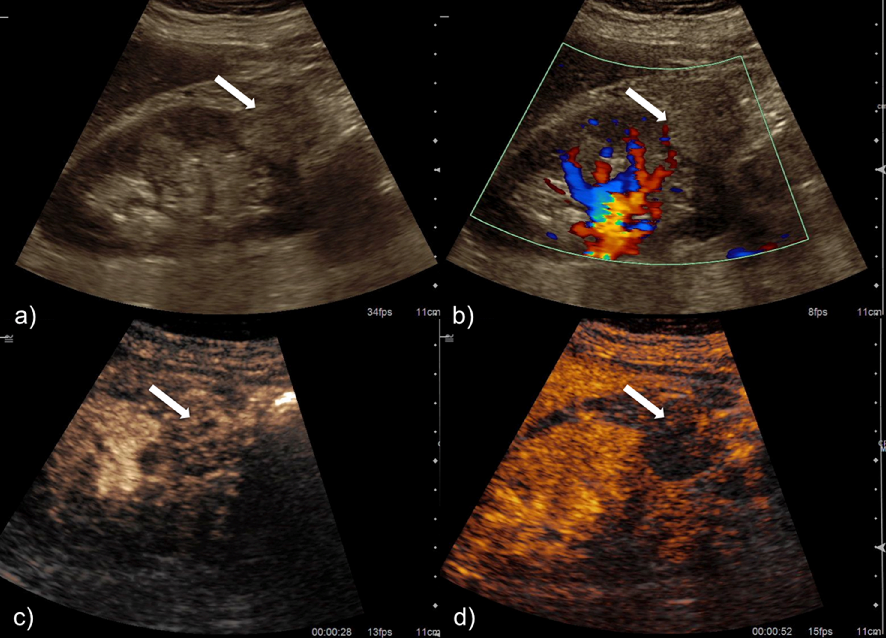 Papillary renal cell carcinoma in contrast-enhanced ultrasound (CEUS ...