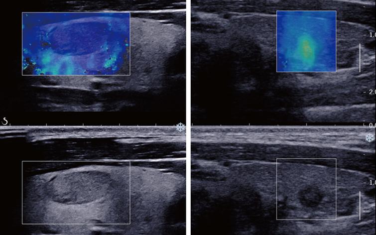 Guidelines and recommendations on the clinical use of shear wave ...