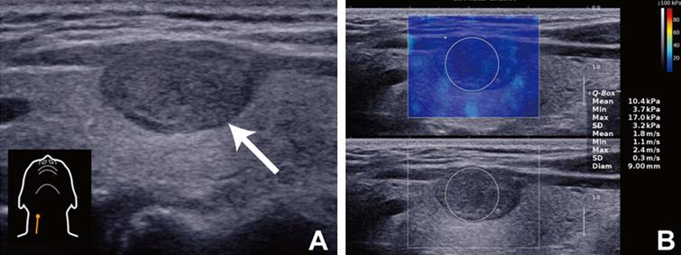 Guidelines and recommendations on the clinical use of shear wave ...