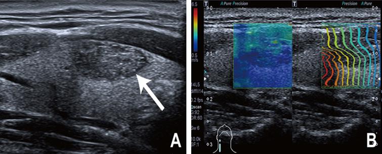 Guidelines and recommendations on the clinical use of shear wave ...