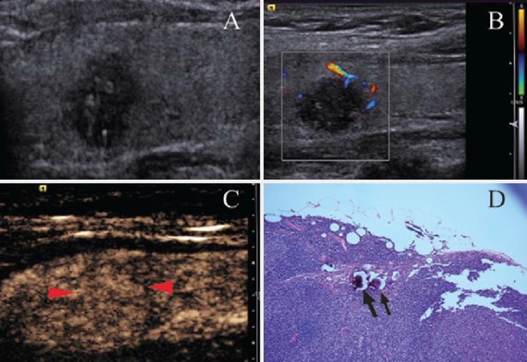 Predicting cervical lymph node metastasis in patients with papillary ...