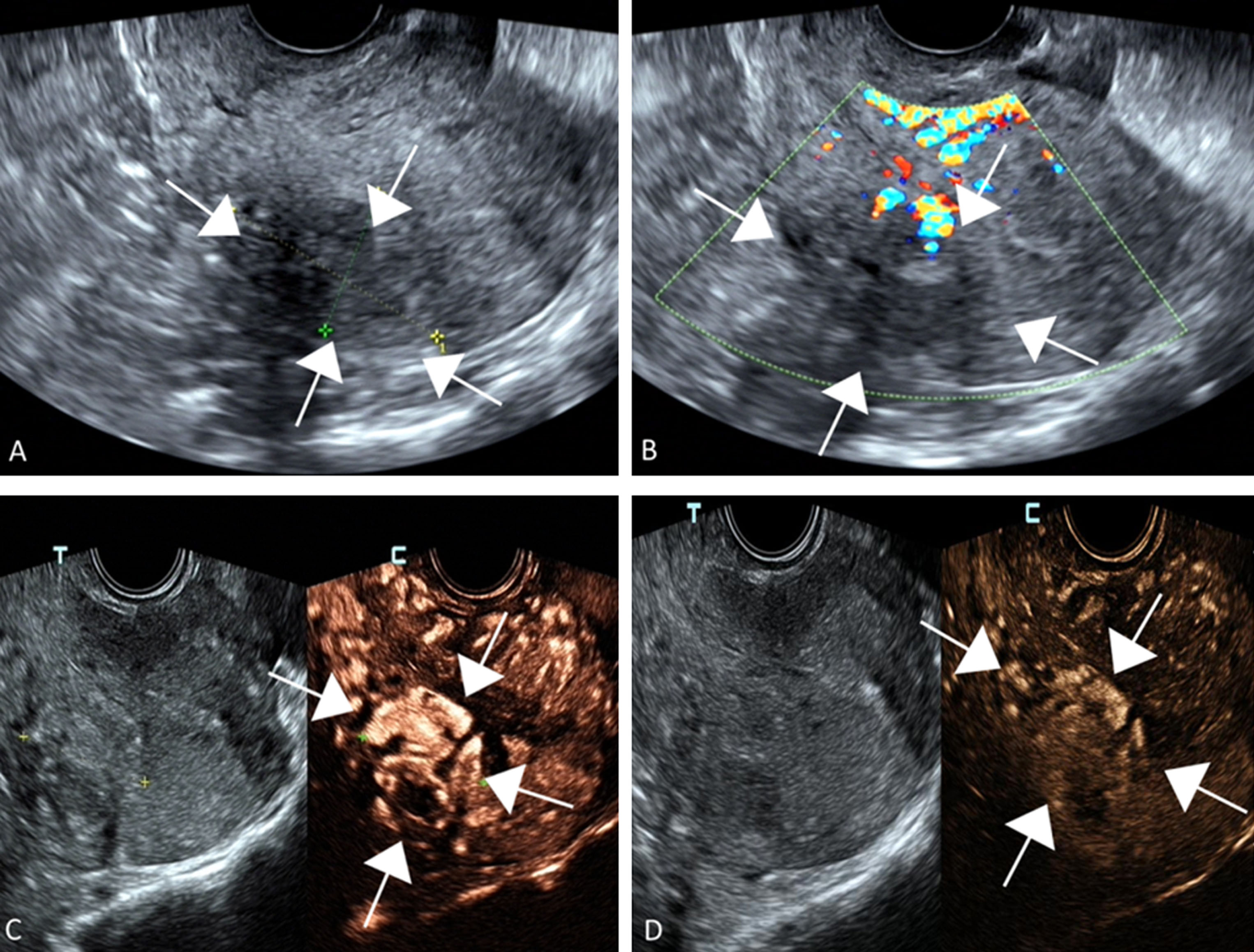 Uterine arteriovenous malformation combined with iliac arteriovenous ...