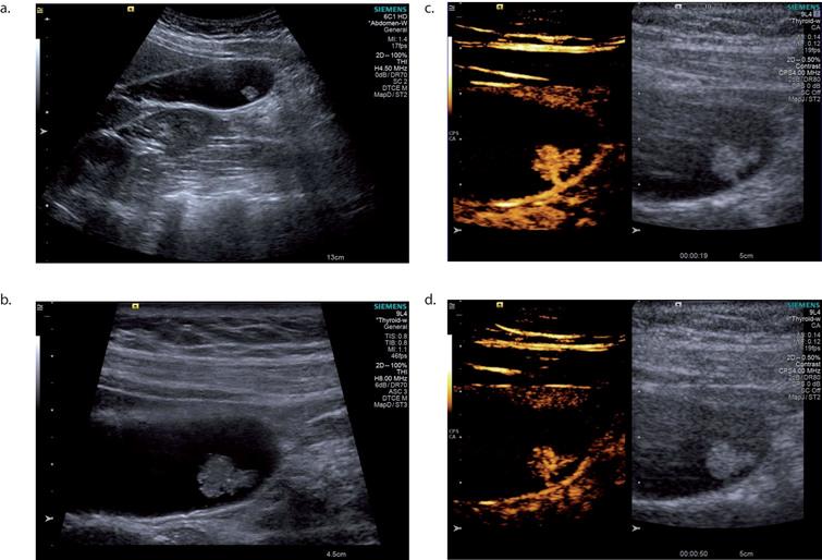 Differential diagnosis of focal gallbladder lesions: The added value of ...