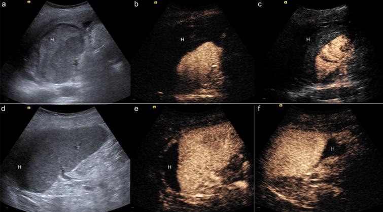 Vascular pattern and diagnostic accuracy of contrast-enhanced ...