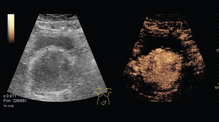 enlarged prostate ultrasound