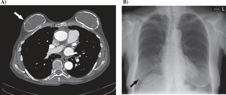 Imaging of breast implant and implant-associated complications