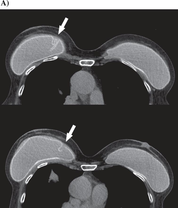 Imaging of breast implant and implant-associated complications