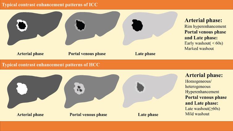 Differentiation between hepatocellular carcinoma and intrahepatic ...