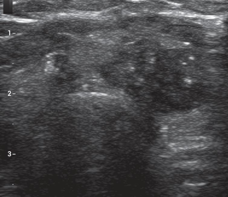 ACR TI-RADS and ATA ultrasound classifications are helpful for the ...