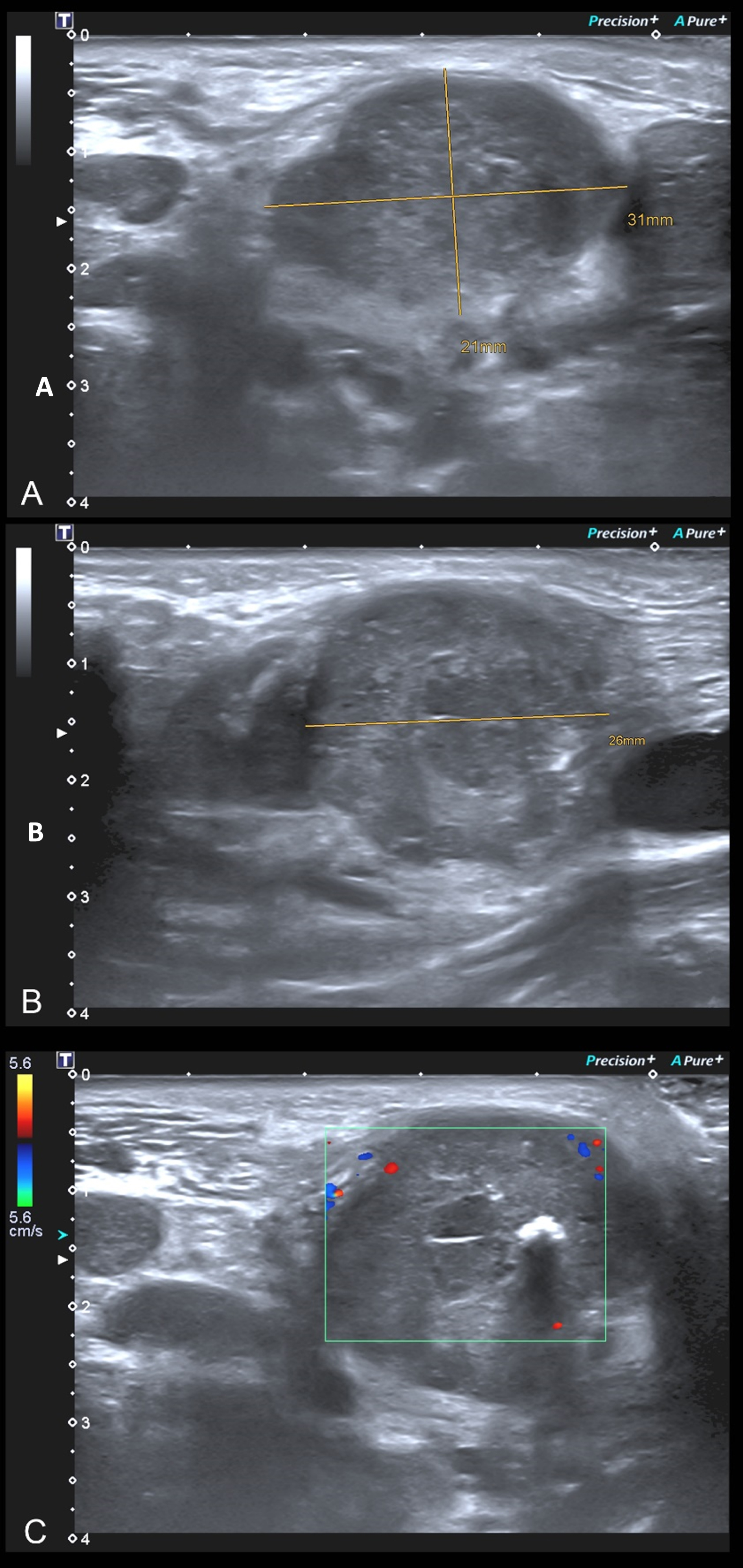 Efficacy And Safety Of Ultrasound Guided Core Needle Biopsies Us Cnbs