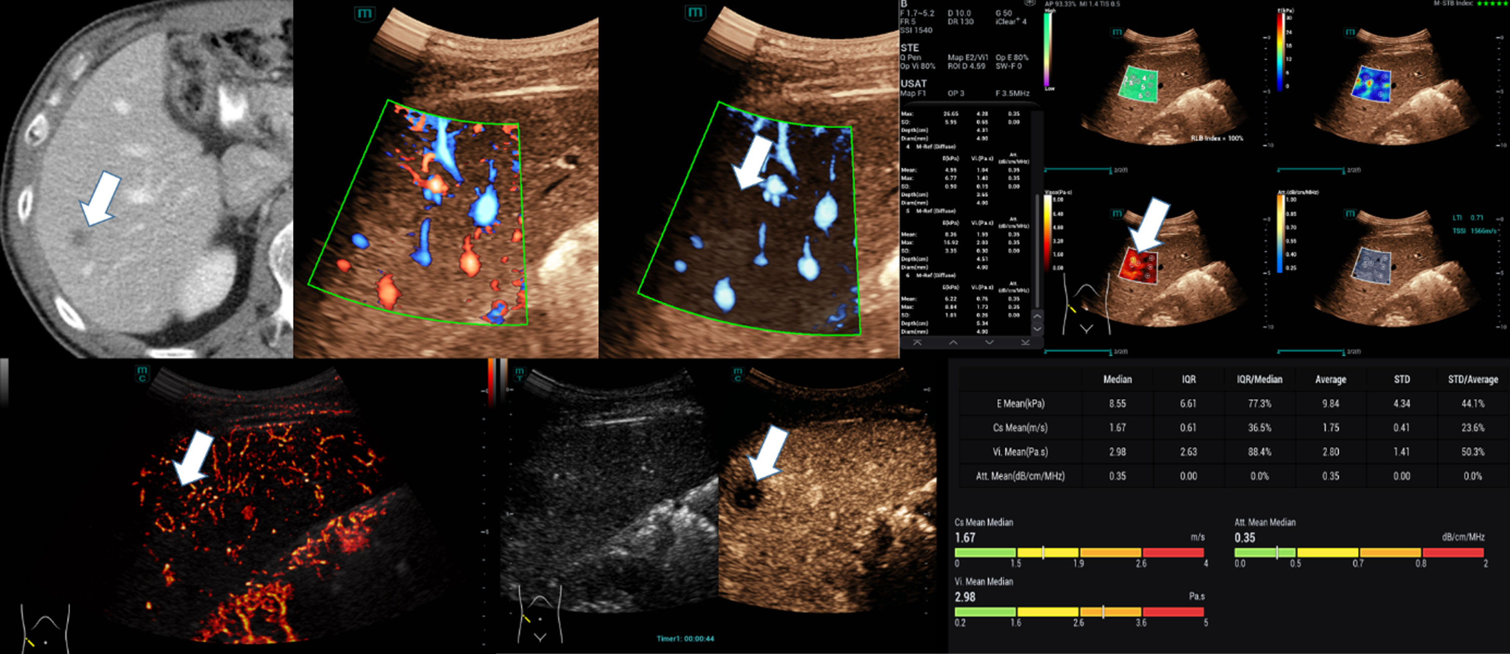 Novel High Resolution Contrast Agent Ultrasound Techniques Hifr Ceus And Sr Ceus In Combination 7125