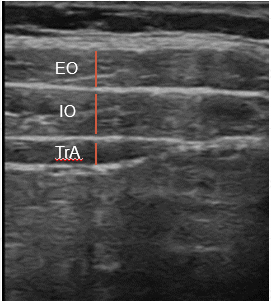 The Effects Of Abdominal Hollowing And Bracing On Abdominal Muscle ...