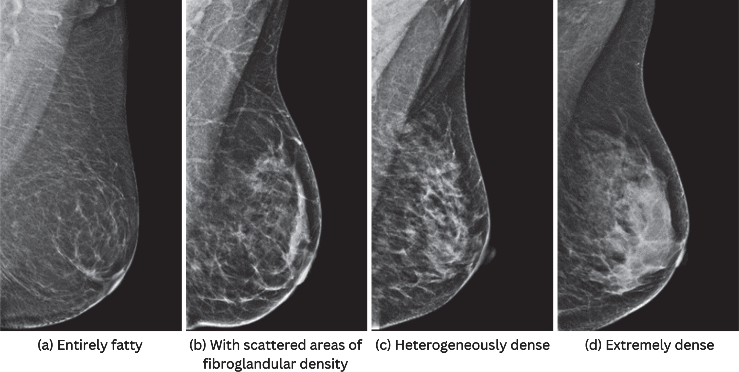 Breast density classification in mammograms using VGG convolutional ...