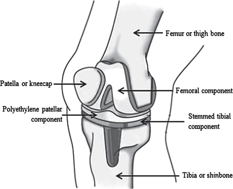 Material selection for femoral component of total knee replacement ...