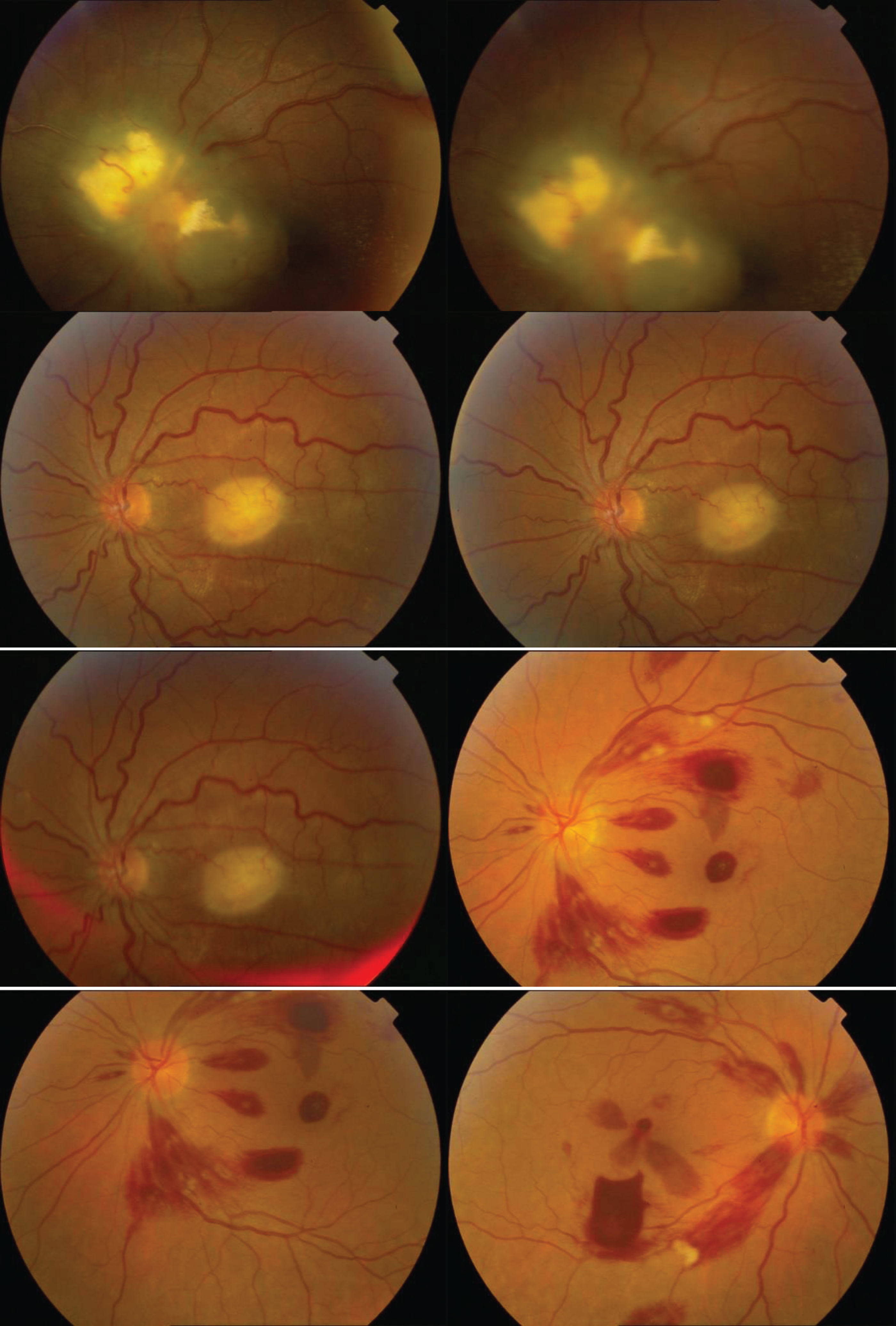 An Efficient Multistage Segmentation Method For Accurate Hard Exudates ...