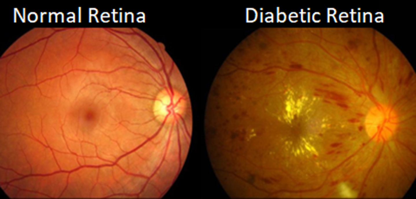 Image based early detection of diabetic retinopathy A systematic ...