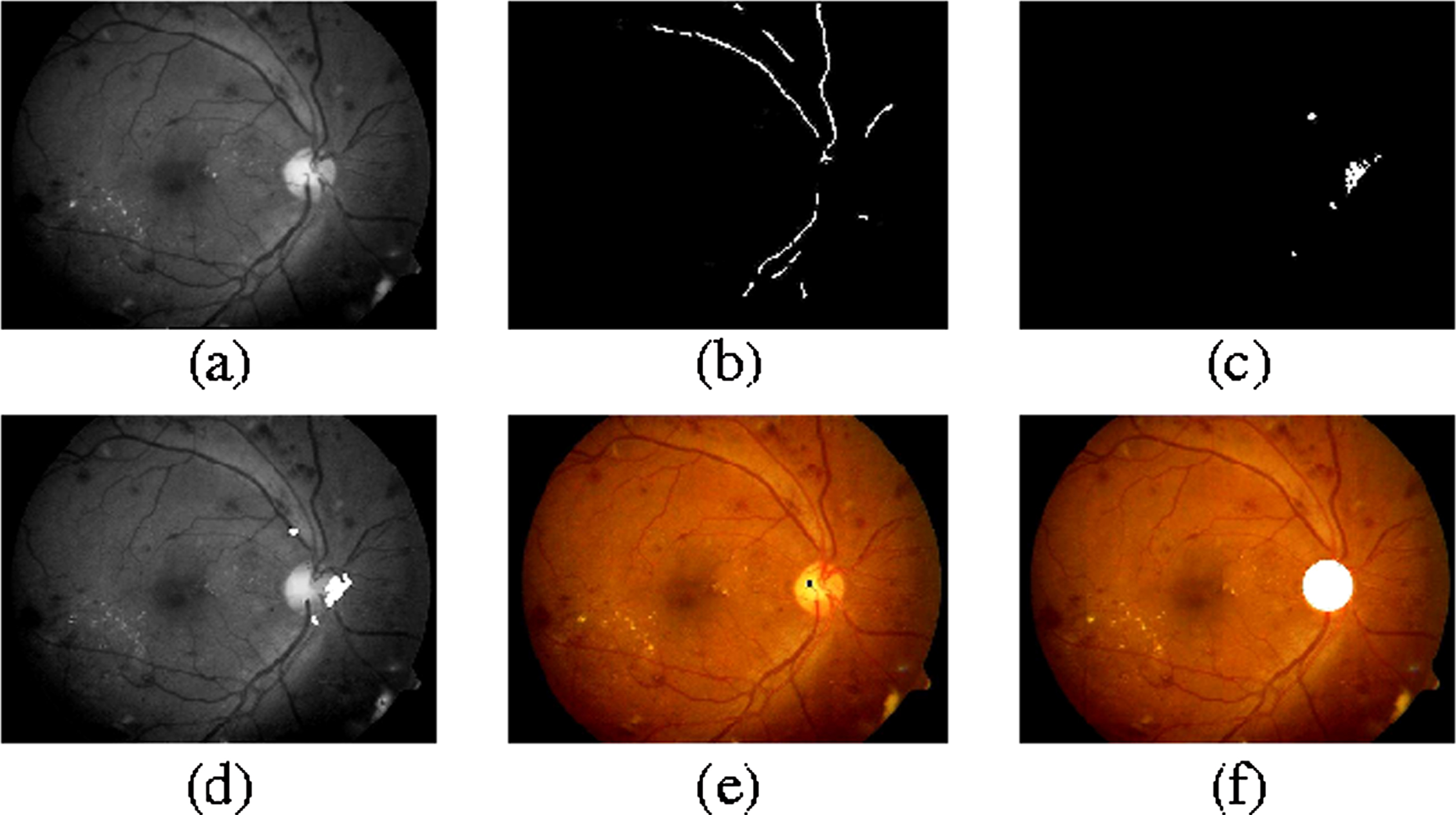 Image based early detection of diabetic retinopathy A systematic ...