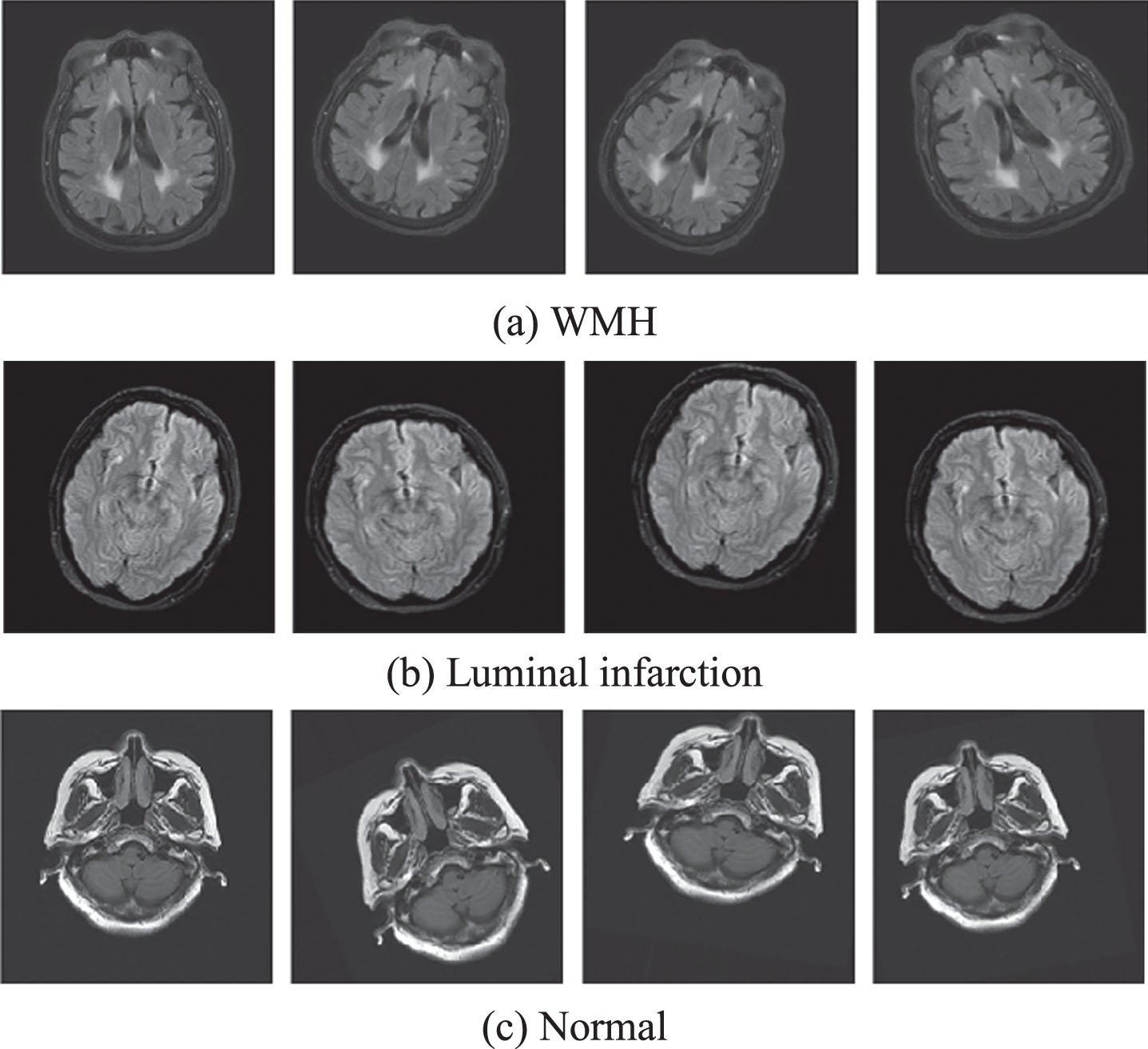 Frontiers  Fully Automatic Classification of Brain Atrophy on NCCT Images  in Cerebral Small Vessel Disease: A Pilot Study Using Deep Learning Models