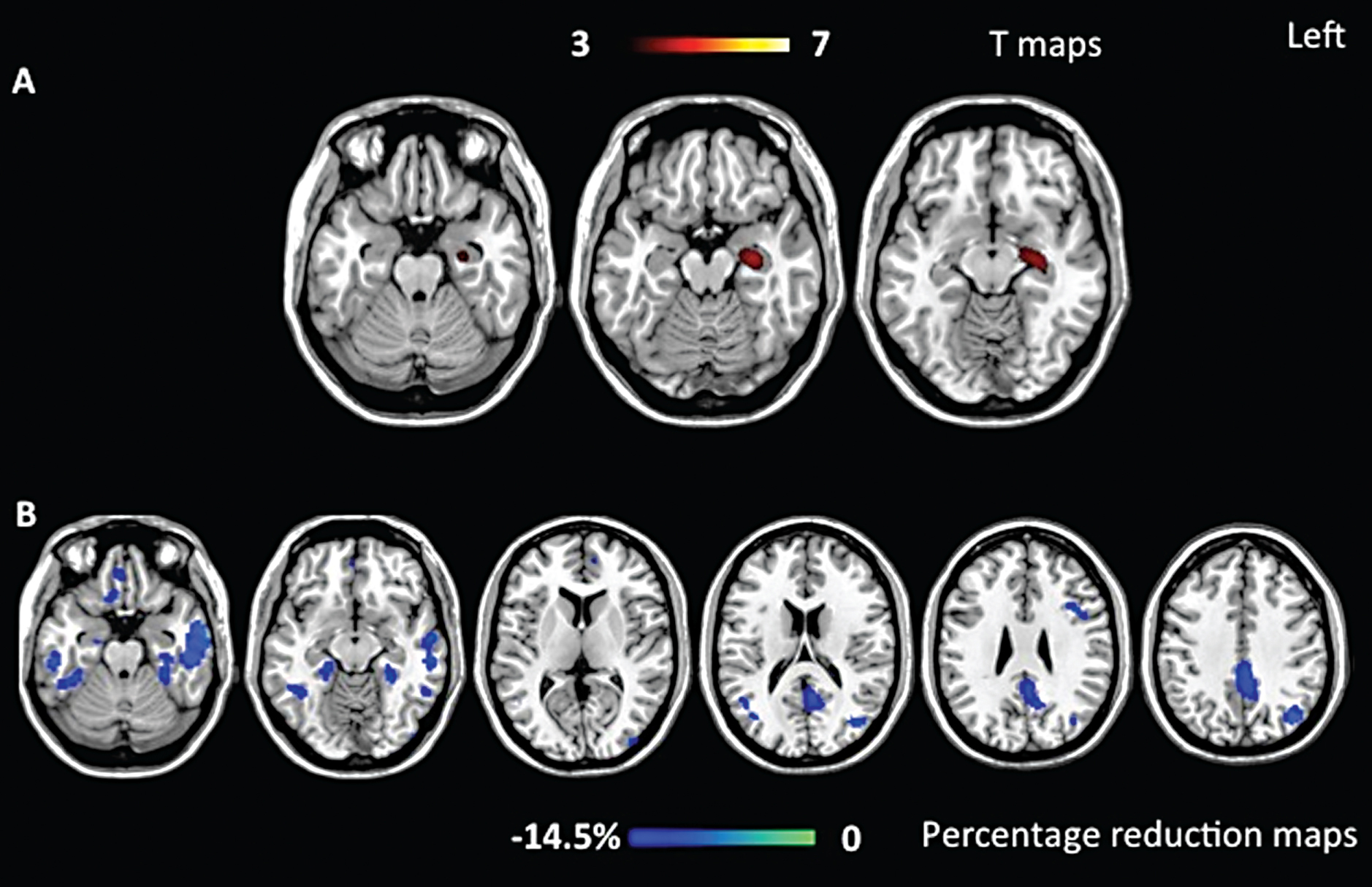 Mapping The Progression Of Atrophy In Early- And Late-Onset Alzheimer’s ...