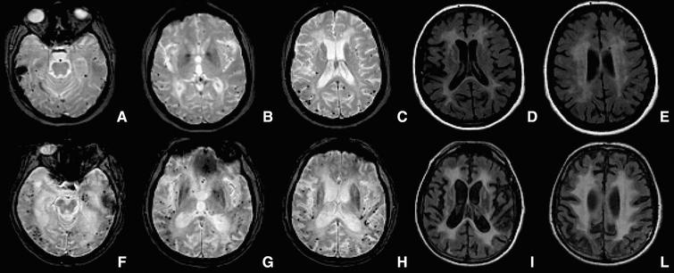 Multiple Spontaneous Cerebral Microbleeds And Leukoencephalopathy In 