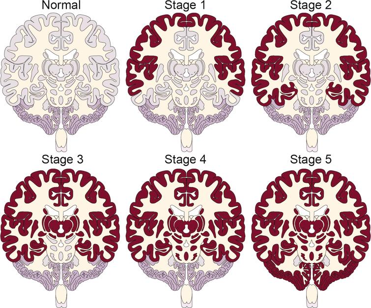 Neuronal Activity and Amyloid Plaque Pathology: An Update - IOS Press