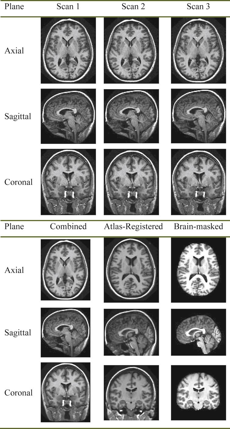 Detection Of Alzheimer’s Disease By Three Dimensional Displacement Field Estimation In