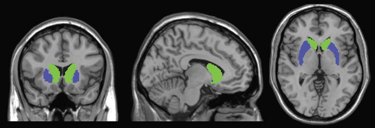 Longitudinal Alteration of Intrinsic Brain Activity in the Striatum in ...