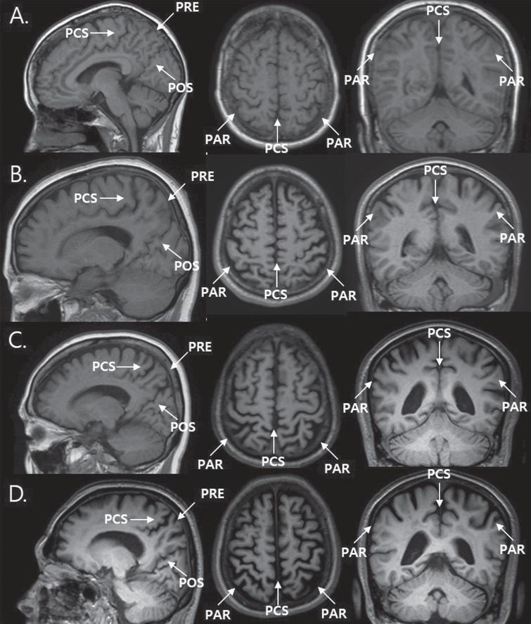 visual-rating-of-posterior-atrophy-as-a-marker-of-progression-to