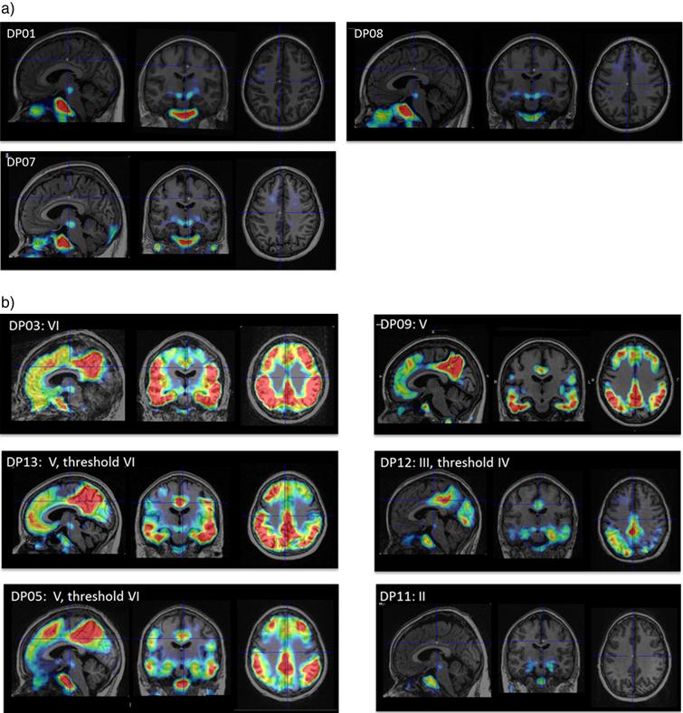 PET Imaging of Tau Pathology and Relationship to Amyloid, Longitudinal ...